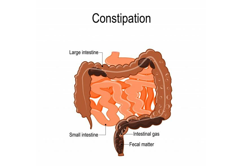 Constipation Treatment test in Gurgaon & Dehli NCR