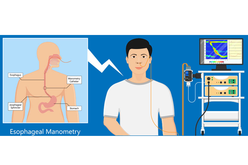 Esophageal manometry test in Gurgaon & Dehli NCR