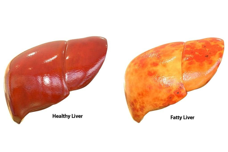 Fatty Liver Treatment test in Gurgaon & Dehli NCR