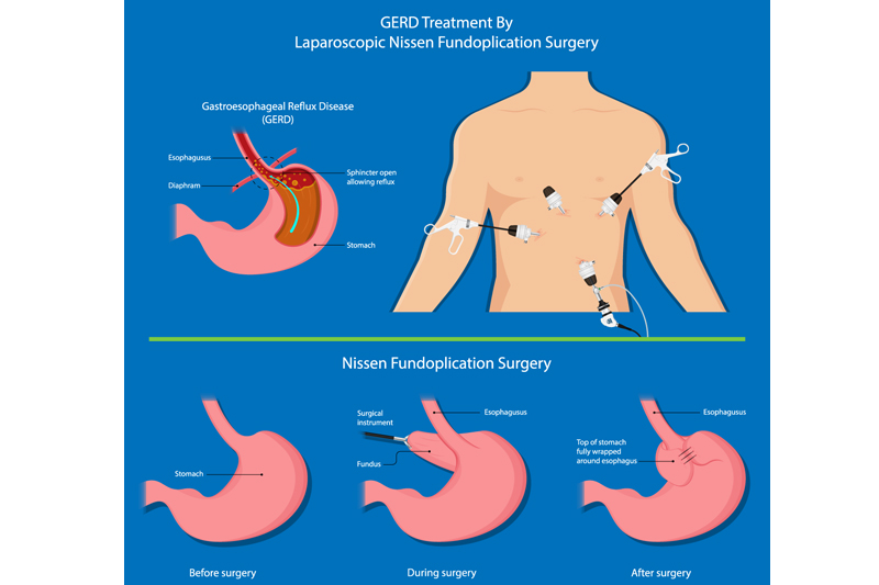 GERDx test in Gurgaon & Dehli NCR