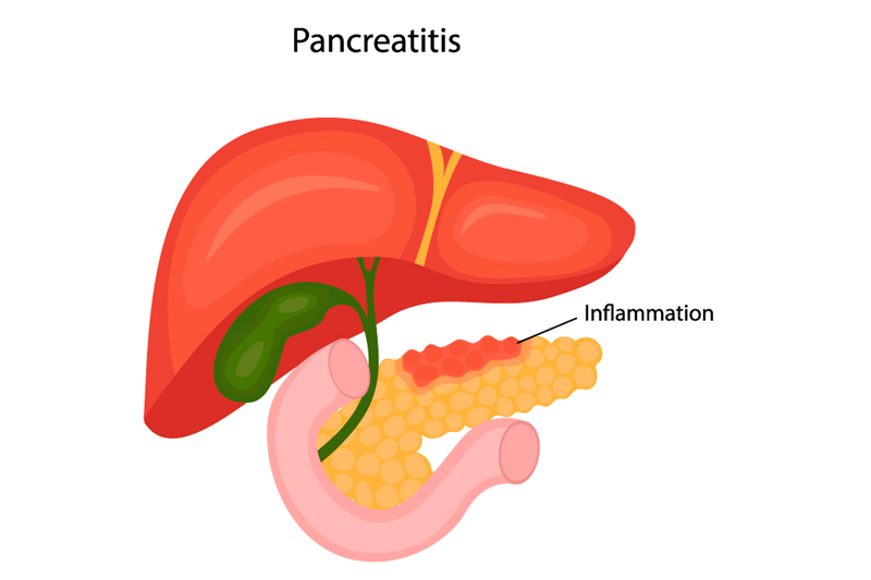 Endoscopic Retrograde Cholangio-Pancreatography (ERCP) test in Gurgaon & Dehli NCR