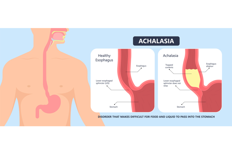 Per Oral Endoscopic Myotomy test in Gurgaon & Dehli NCR